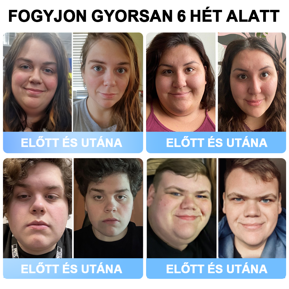 đFormaĂletÂź đ±Nano MikrotƱ Tapasz SMGT-GLP-1-tel Ă©s Matrixyl 3000-rel â FogyĂĄs, BĆrfeszesĂtĂ©s, VĂ©rcukorszint-tĂĄmogatĂĄs, InjekciĂł NĂ©lkĂŒl, 7 Napos EredmĂ©ny đ