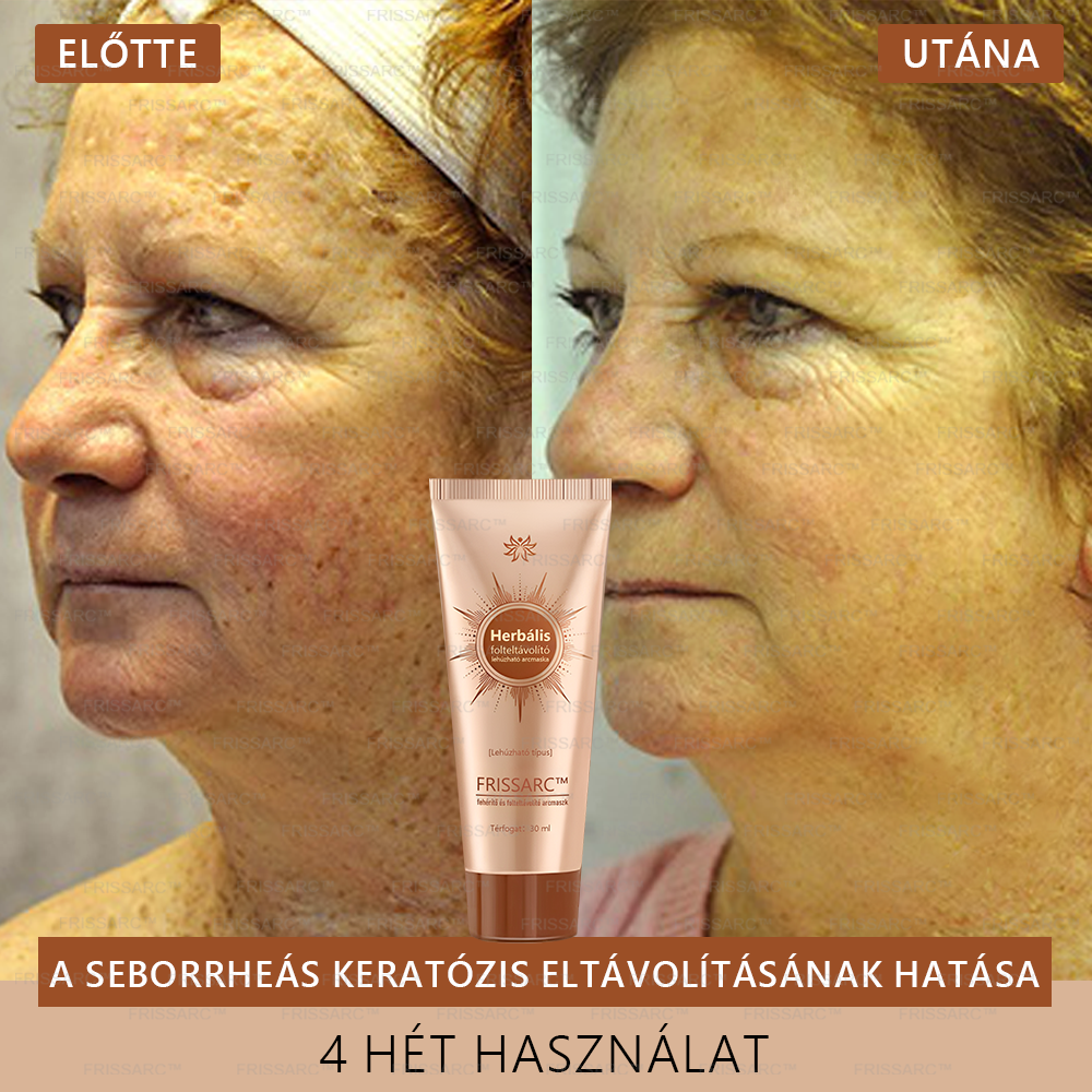 ✨ 𝐅𝐑𝐈𝐒𝐒𝐀𝐑𝐂™ Fehérítő És Folteltávolító Arcmaszk | Természetes összetevők tartósan eltüntetik a foltokat, szeplőket és napfoltokat🔥